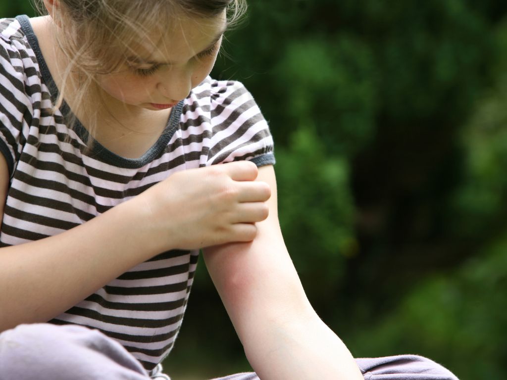 picada do mosquito cria reação alérgica à criança